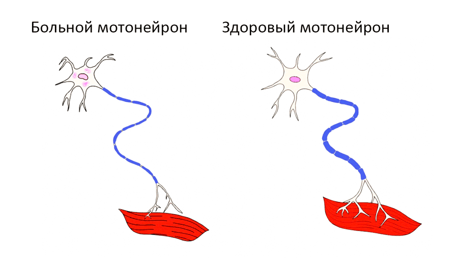 Новый соединить. Повреждение двигательного нейрона. Восстанавливает поврежденные Нейроны. Верхние двигательные Нейроны. Шиповатый Нейроны стриатума.